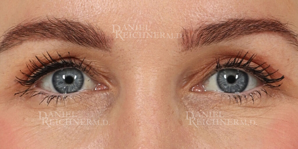 Eyelid Surgery Case 19240 After Photo Eyelid Surgery