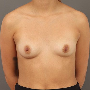 Breast Augmentation