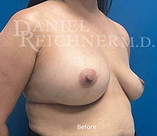 Breast Implant Exchange