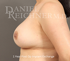 Breast Implant Exchange