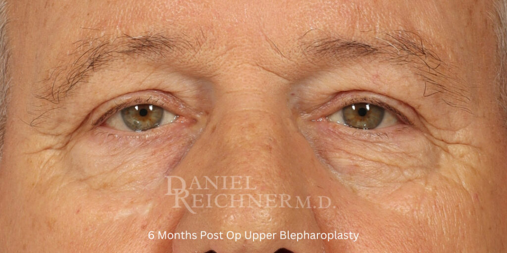 Eyelid Surgery
