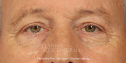 Eyelid Surgery