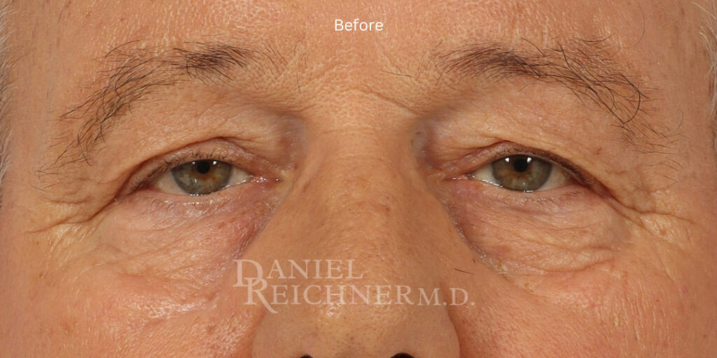 Eyelid Surgery
