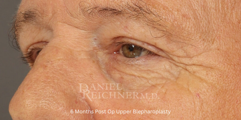 Eyelid Surgery