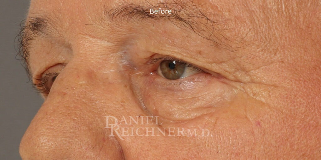 Eyelid Surgery