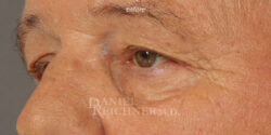 Eyelid Surgery