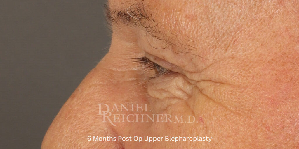 Eyelid Surgery