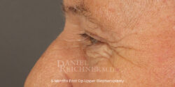 Eyelid Surgery