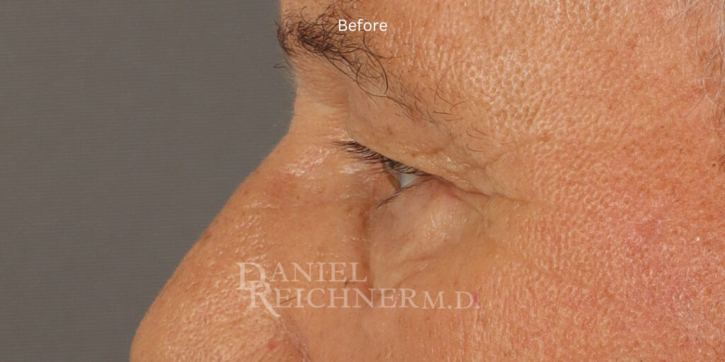 Eyelid Surgery