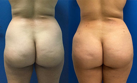 fat transfer bbl before and after photo by reichner plastic surgery in orange ca