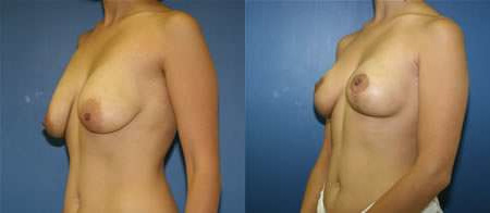 breast lift before and after photo by reichner plastic surgery in orange ca