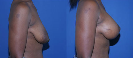 breast lift before and after photo by reichner plastic surgery in orange ca