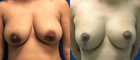 breast lift before and after photo by reichner plastic surgery in orange ca