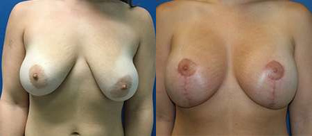 breast lift before and after photo by reichner plastic surgery in orange ca