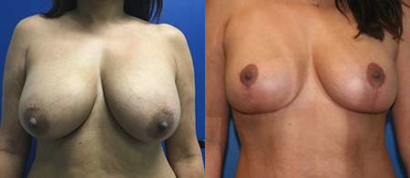 breast lift before and after photo by reichner plastic surgery in orange ca