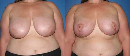 breast lift before and after photo by reichner plastic surgery in orange ca