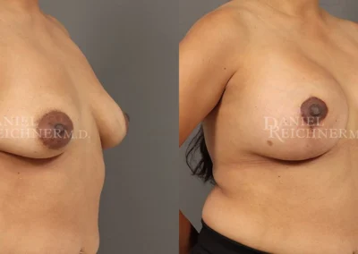 breast lift with augmentation before and after photo by reichner plastic surgery in orange ca