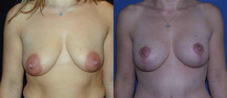 breast lift with augmentation before and after photo by reichner plastic surgery in orange ca