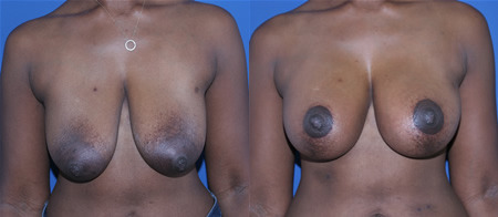 breast lift with augmentation before and after photo by reichner plastic surgery in orange ca