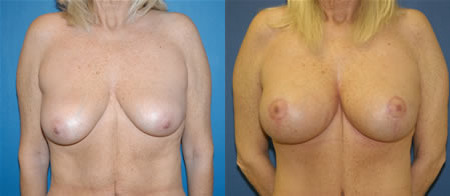breast lift with augmentation before and after photo by reichner plastic surgery in orange ca