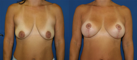 breast lift with augmentation before and after photo by reichner plastic surgery in orange ca