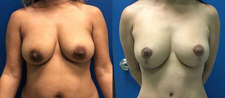 breast lift with augmentation before and after photo by reichner plastic surgery in orange ca