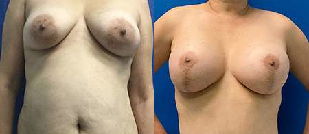 breast lift with augmentation before and after photo by reichner plastic surgery in orange ca
