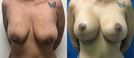 breast lift with augmentation before and after photo by reichner plastic surgery in orange ca