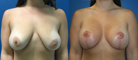 breast lift with augmentation before and after photo by reichner plastic surgery in orange ca