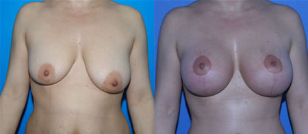 breast lift with augmentation before and after photo by reichner plastic surgery in orange ca