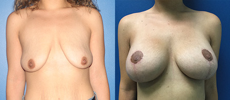 breast lift with augmentation before and after photo by reichner plastic surgery in orange ca