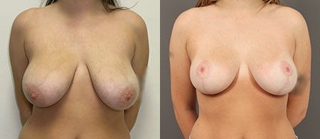 breast reduction before and after photo by reichner plastic surgery in orange ca