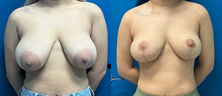 breast reduction before and after photo by reichner plastic surgery in orange ca