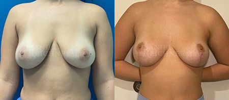 breast reduction before and after photo by reichner plastic surgery in orange ca