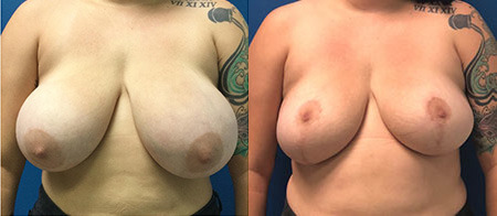 breast reduction before and after photo by reichner plastic surgery in orange ca