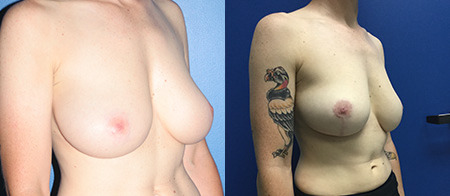 breast reduction before and after photo by reichner plastic surgery in orange ca
