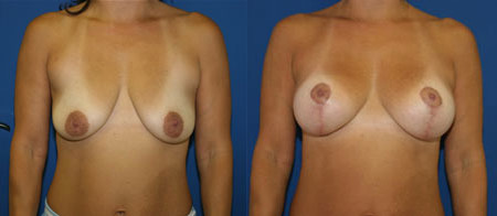 breast reduction before and after photo by reichner plastic surgery in orange ca