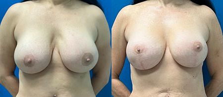 breast revision before and after photo by reichner plastic surgery in orange ca