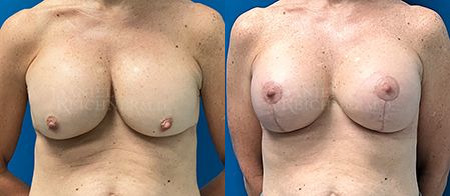 breast revision before and after photo by reichner plastic surgery in orange ca