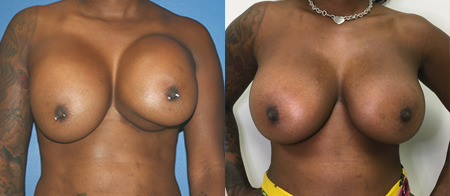 breast revision before and after photo by reichner plastic surgery in orange ca