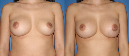 breast revision before and after photo by reichner plastic surgery in orange ca