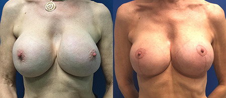 breast revision before and after photo by reichner plastic surgery in orange ca