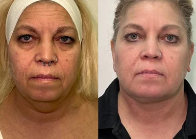 facial fat grafting before and after photo by reichner plastic surgery in orange ca