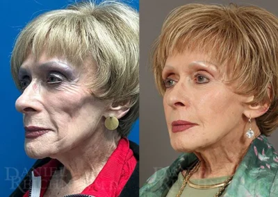 facial fat grafting before and after photo by reichner plastic surgery in orange ca
