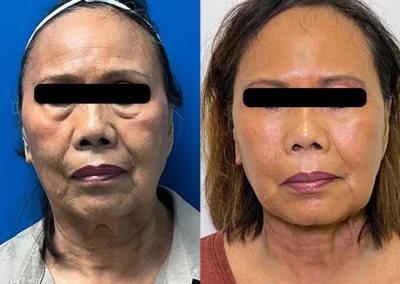 facial fat grafting before and after photo by reichner plastic surgery in orange ca