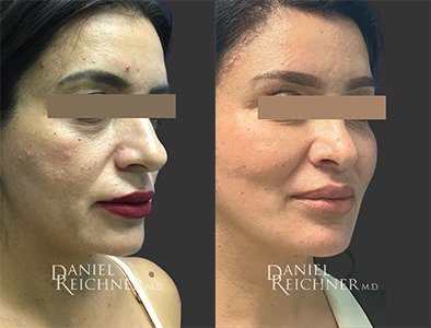 facial fat grafting before and after photo by reichner plastic surgery in orange ca