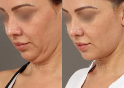 mini necklift before and after photo by reichner plastic surgery in orange ca