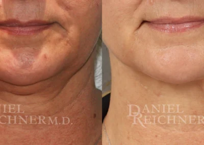 face liposuction before and after photo by reichner plastic surgery in orange ca