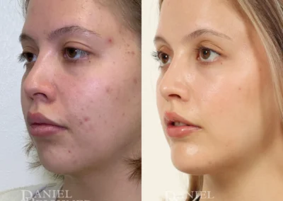 chin augmentation before and after photo by reichner plastic surgery in orange ca