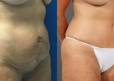 abdominoplasty tummy tuck before and after photo by reichner plastic surgery in orange ca